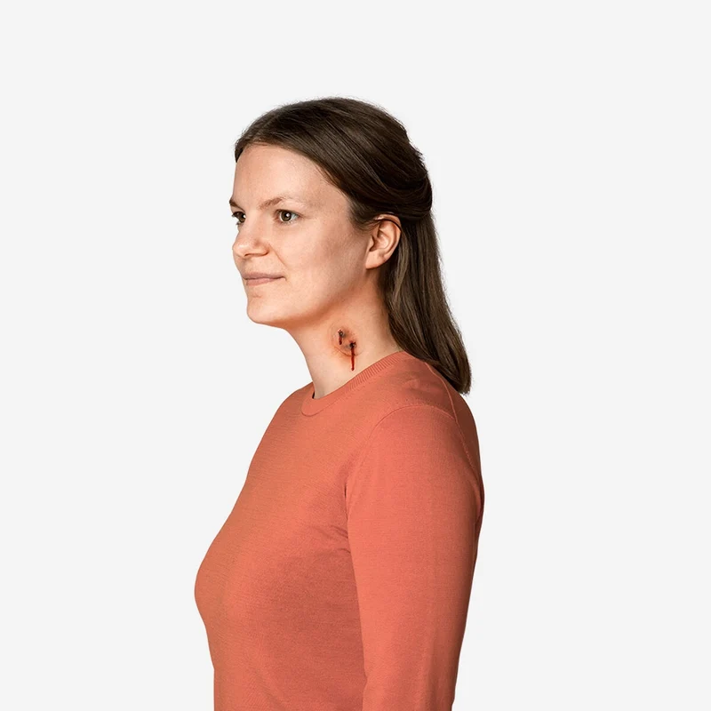 Vampire bite. Adhesive